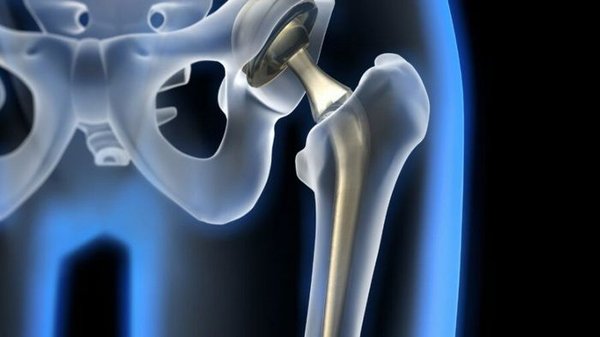 Ako sa vykonáva operácia náhrady bedrového kĺbu?